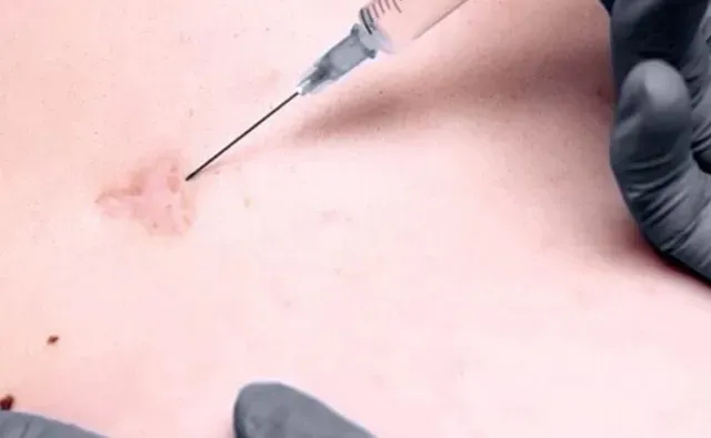 What is keloid injection?