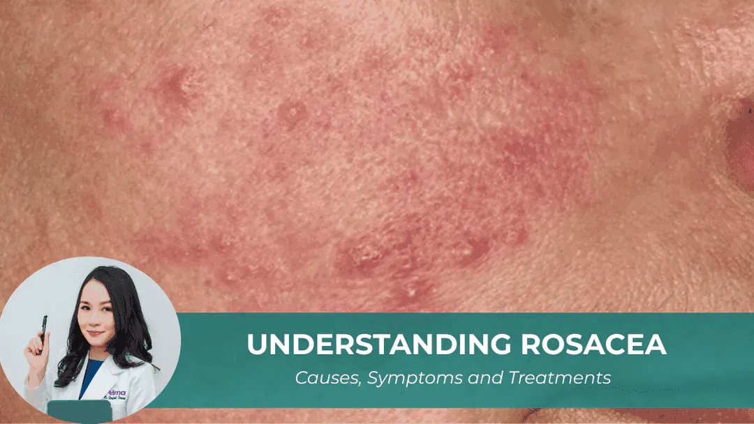 Understanding Rosacea: Causes, Symptoms and Treatments