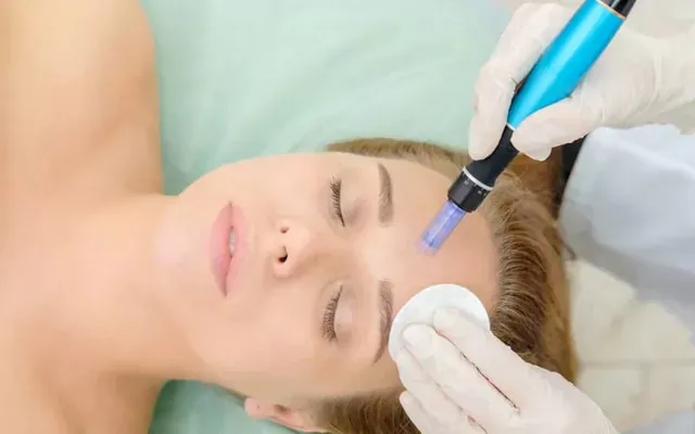 RF Needling