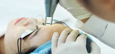Derma Acne Clear - Spectra Laser