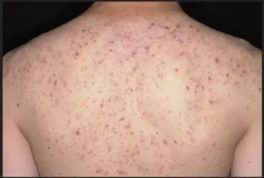 Body Acne Treatment