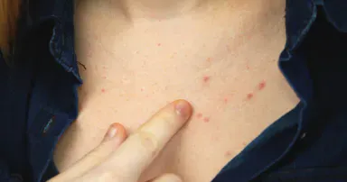 Các loại mụn trên cơ thể