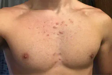 Những tác hại của mụn cơ thể