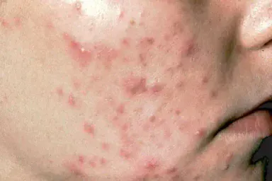 The Effects of Body Acne
