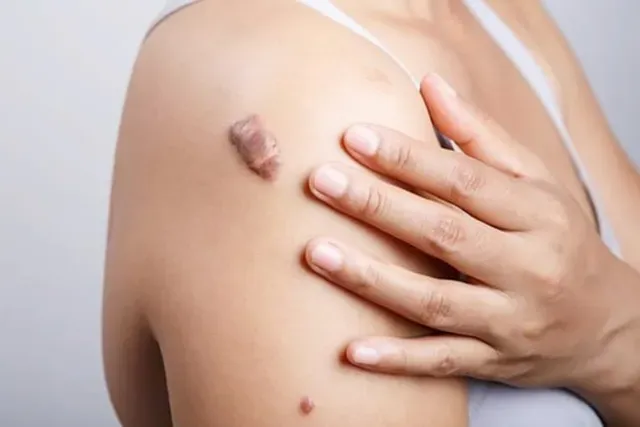 Hiệu quả của tiêm sẹo