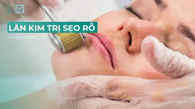 Lăn kim trị sẹo rỗ giá bao nhiêu?