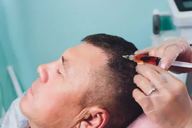 Hói đầu ở nam giới: nguyên nhân, giai đoạn và cách điều trị tại TP.HCM