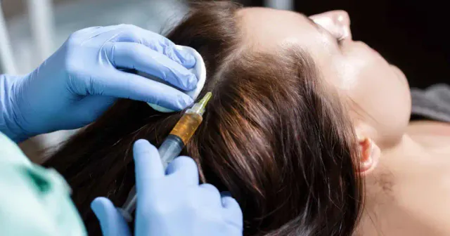 Trị rụng tóc ở nữ và rụng tóc sau sinh tại WeDo Skin Clinic