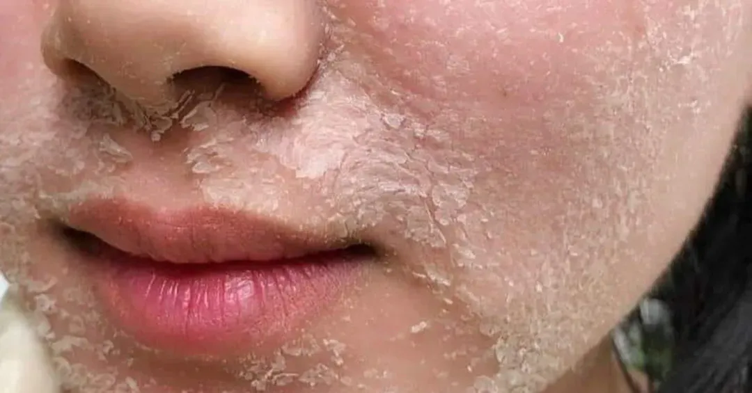 Peel da làm sáng, mờ thâm (Dermalogica)