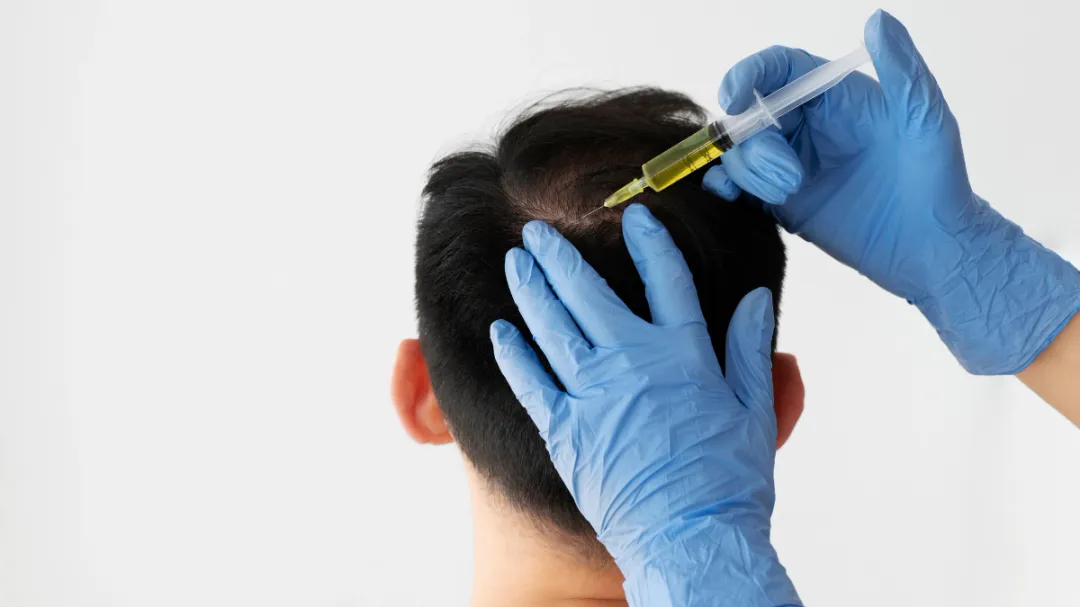 PRP for Hair Loss Treatment