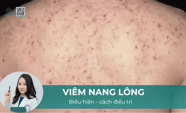 Viêm nang lông là gì và điều trị như thế nào?