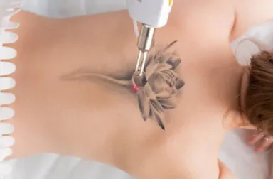 Xoá xăm bằng Laser Nd:Yag 1064