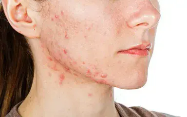 Combo Trị Mụn + Trị Sẹo HCM