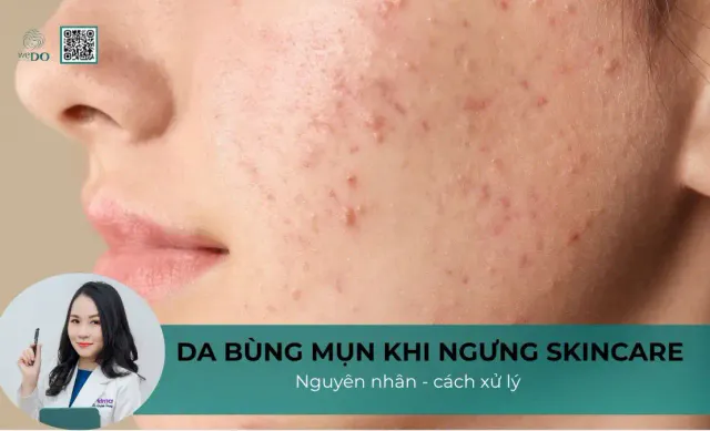 Da bị bùng mụn khi ngưng skincare – nguyên nhân và cách giải quyết