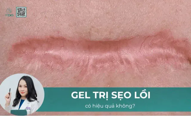 Kem bôi và mẹo tại nhà có làm xẹp sẹo được không?