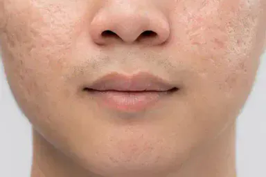 Giá Trị Sẹo Rỗ HCM