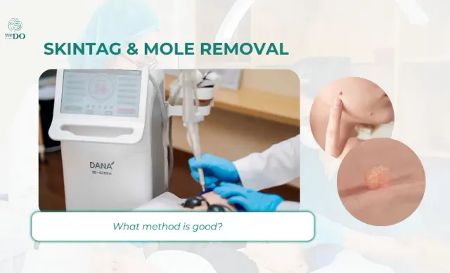 Skintag & Mole removal: What method is good?