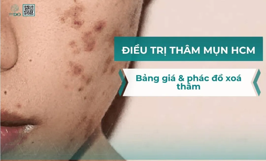 Điều trị thâm mụn HCM: Bảng giá và phác đồ xóa thâm, sáng da chuyên sâu