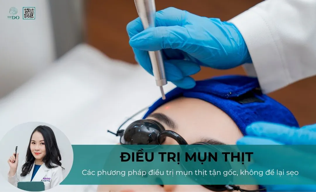 Cách trị mụn thịt tận gốc, không để lại sẹo