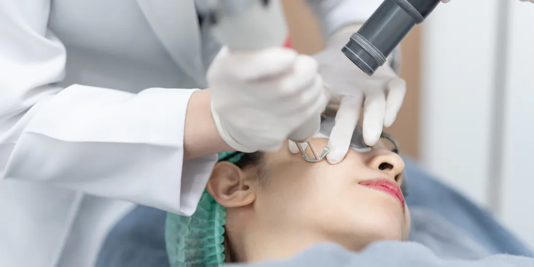 Does Melasma Come Back After Laser Treatment?