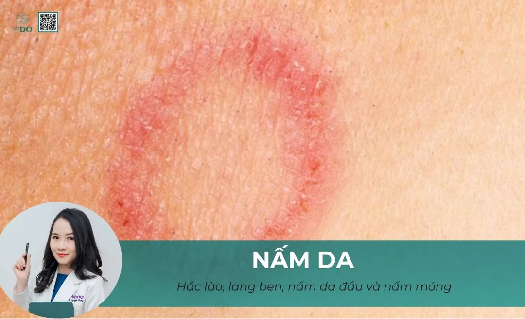 Nấm da: hắc lào, lang ben, nấm da đầu và nấm móng – khám cùng bác sĩ da liễu