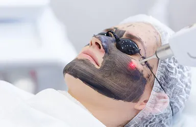 Carbon Peel - Spectra Laser