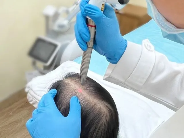 Laser Fractional kích thích mọc tóc: cơ chế, phác đồ và chi phí tại WeDo