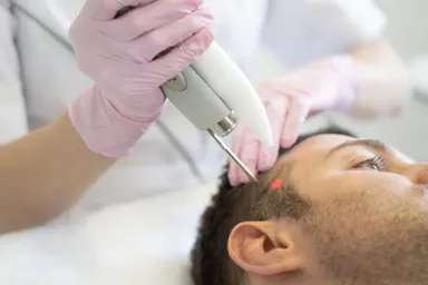 Laser Fractional da đầu là gì?