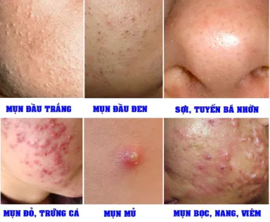 mụn đầu trắng