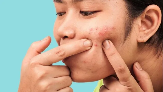 mụn đầu trắng