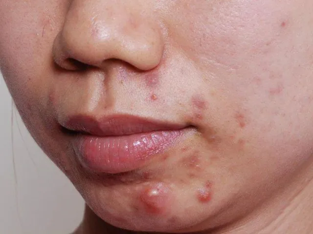 mụn nội tiết ở nữ