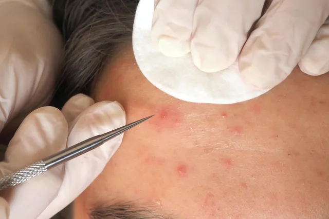 Lấy nhân milia bằng kim vô khuẩn