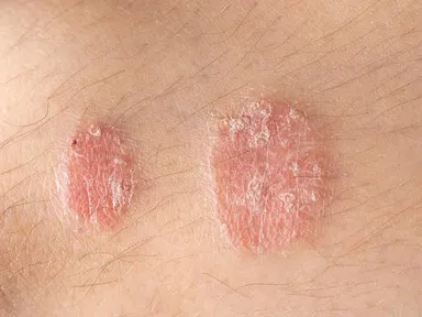 Các thể nấm da thường gặp