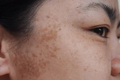 Melasma Treatment in HCM City