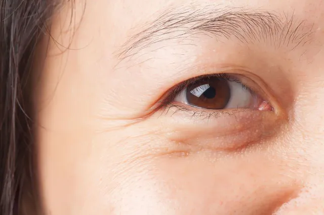 Nếp nhăn động và nếp nhăn tĩnh khác nhau thế nào?