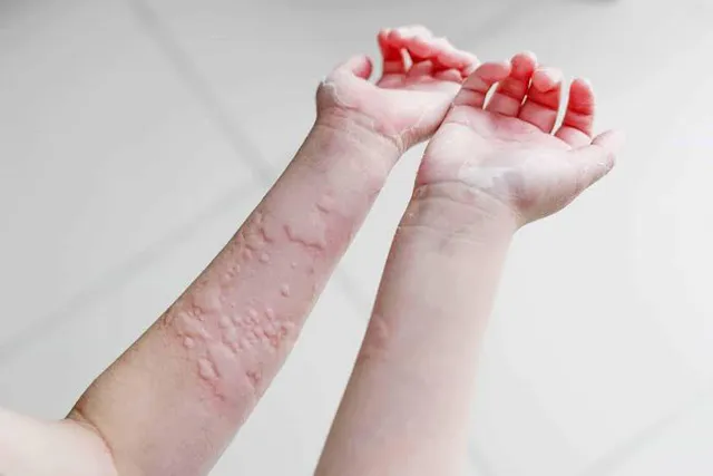 Dấu hiệu của mề đay