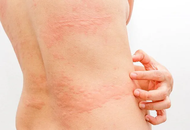 Mề đay cấp hay mạn tính?