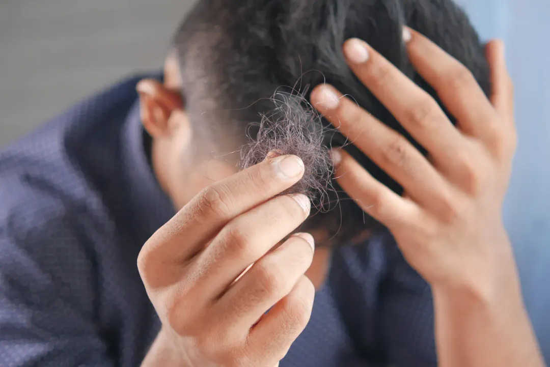 rụng tóc ở nam giới