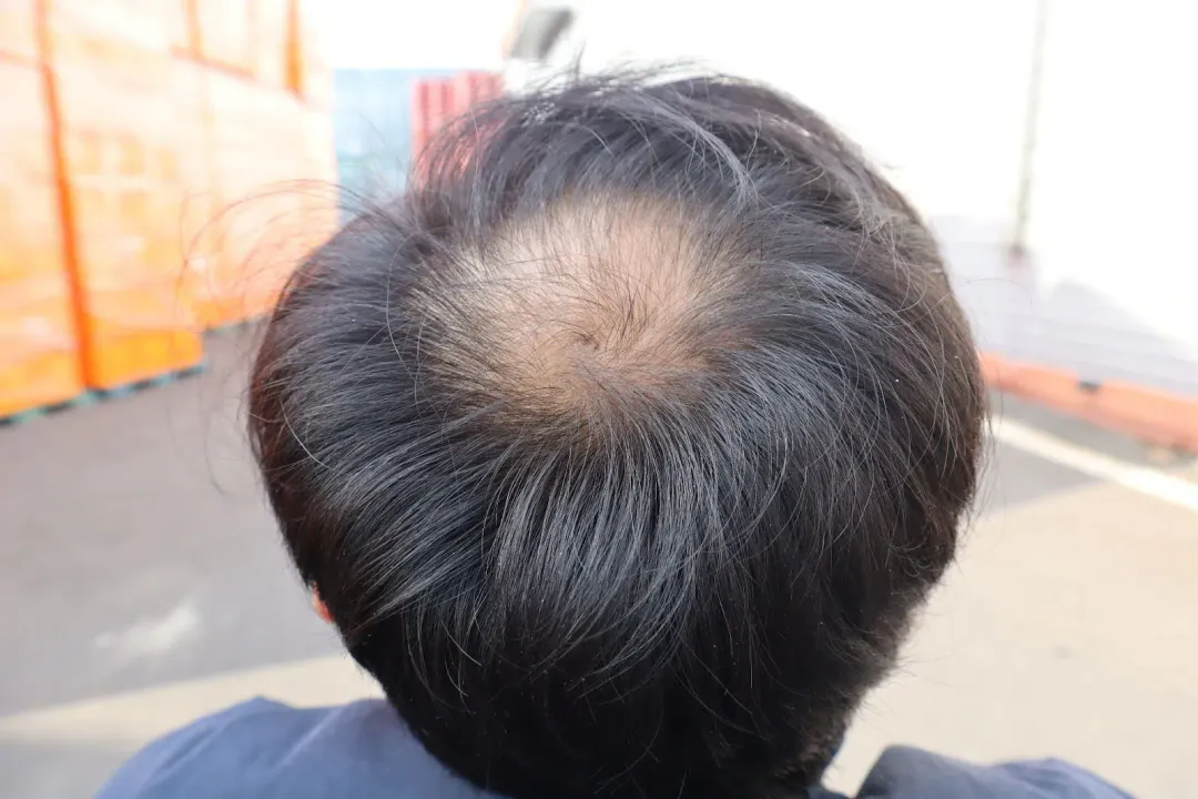 rụng tóc ở nam giới