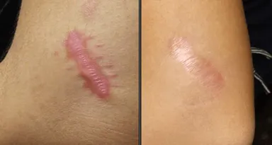 Where do keloids commonly form?
