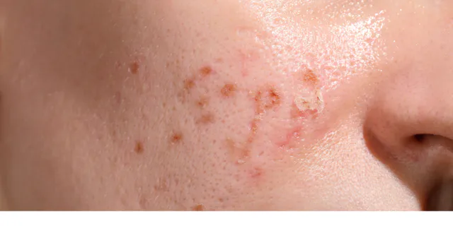 tàn nhang bắn laser