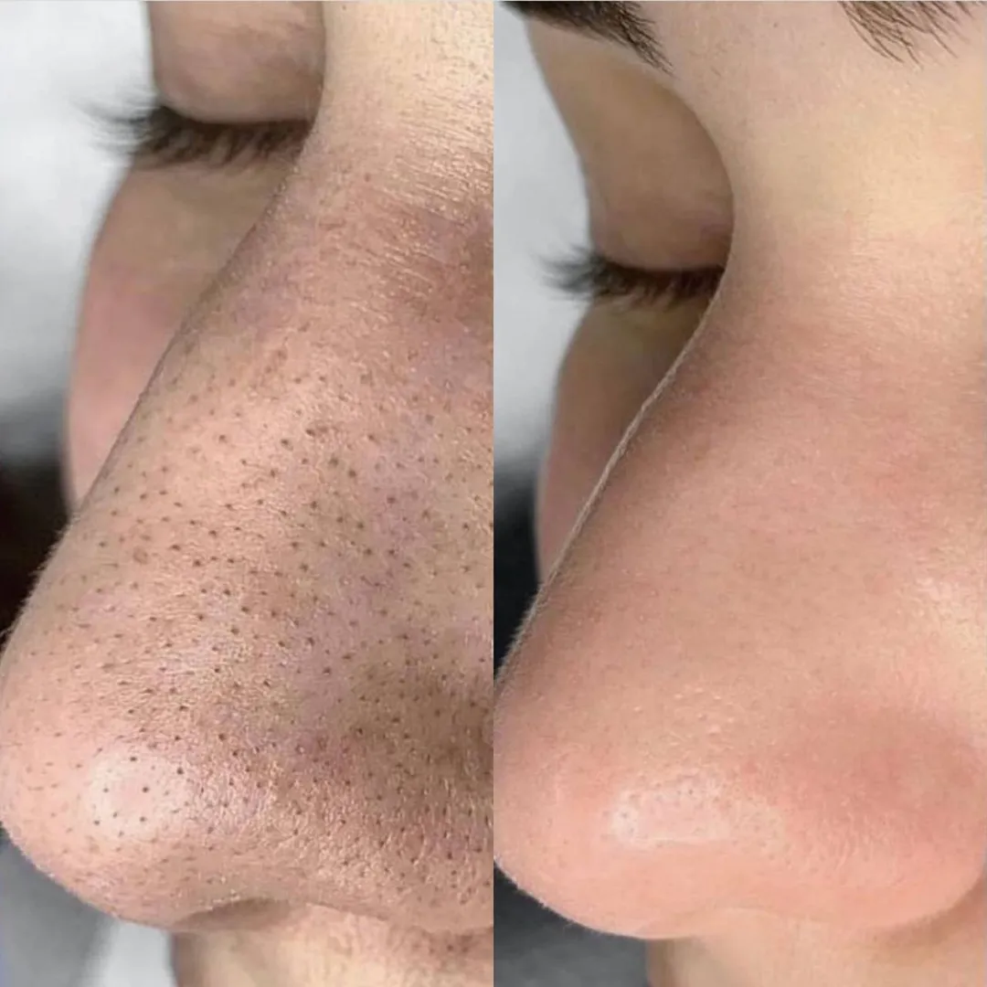 Trị mụn đầu đen chuẩn y khoa tại TP.HCM: lấy nhân, peel và IPL