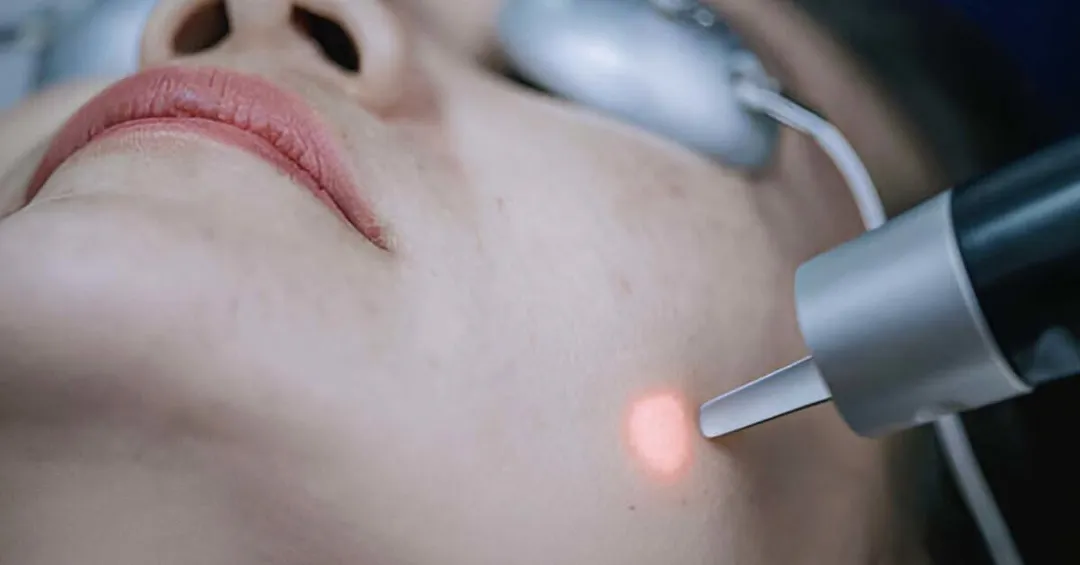 Bắn tàn nhang bao lâu thì bong vảy?
