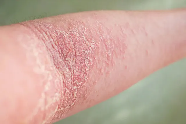 Vảy nến: nhận biết các thể bệnh và điều trị cùng bác sĩ da liễu