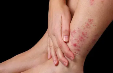 Viêm da cơ địa, viêm da dị ứng và viêm da tiếp xúc khác nhau thế nào?