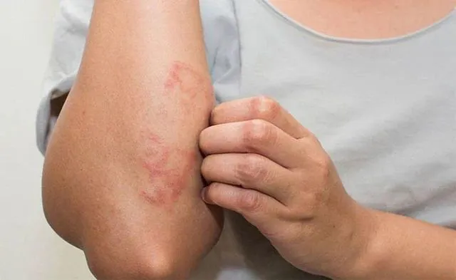 Viêm da cơ địa, dị ứng, tiếp xúc: khám và điều trị cùng bác sĩ da liễu