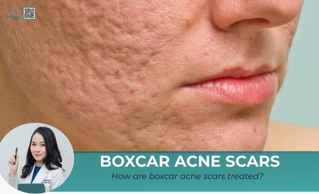 How are boxcar acne scars treated?