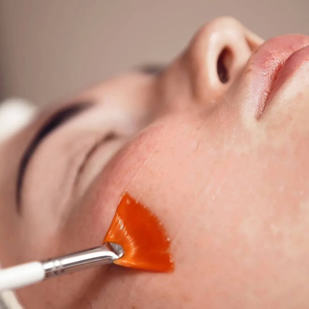 Chemical Peel Cost in HCM City
