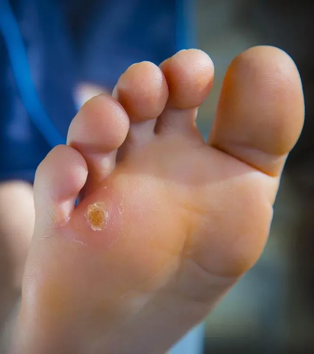 How Much Does Wart Treatment Cost in HCM City?