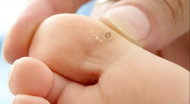 How Much Does Wart Treatment Cost in HCM City?